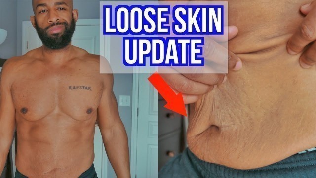 'Loose Skin After Losing 140 Pounds'